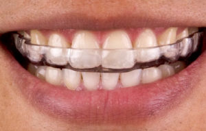 BruxismNightGuard