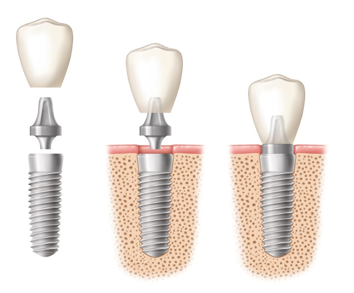 Dental implants