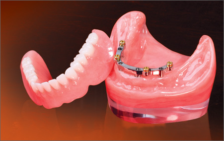 GlidewellImplantOverdenture