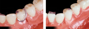 GlidewellPartialDenture