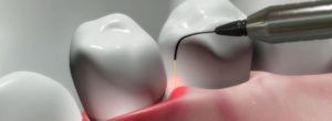 Scaling a tooth