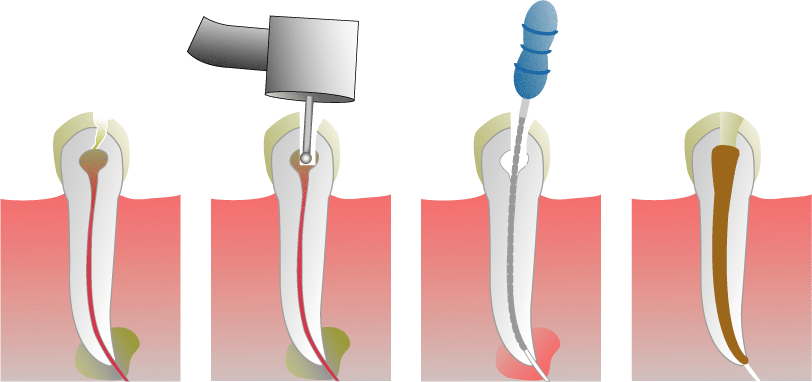 RootCanalIllustration