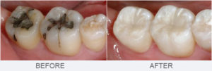 before after fillings