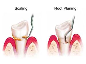 Picture of Scaling and root planing 